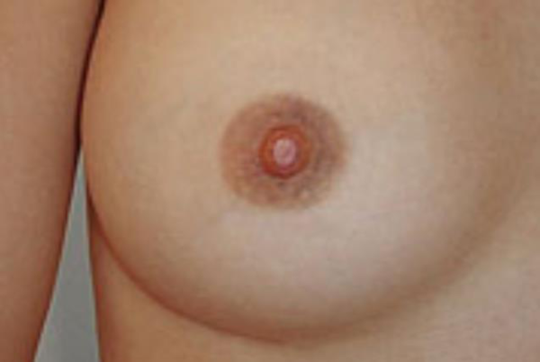 Areola
